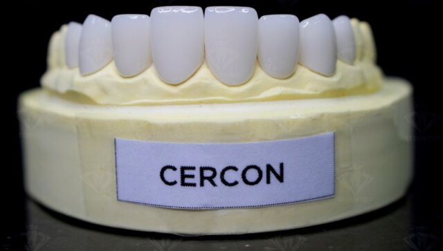 Giới thiệu về răng Cercon