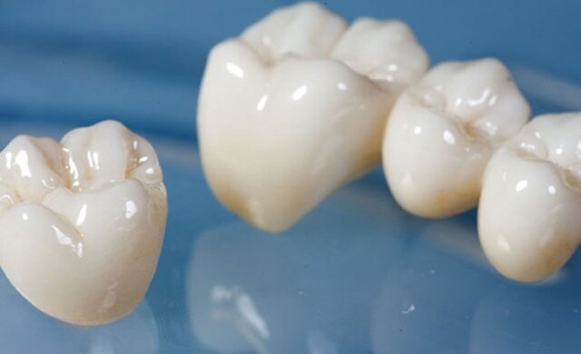 Nên lựa chọn loại răng sứ nào?