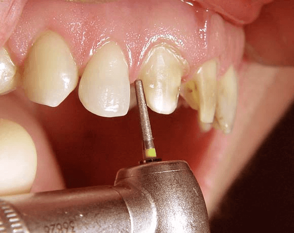 Biện pháp khắc phục tình trạng sâu vị trí răng cửa