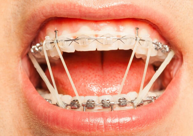 thun-lien-ham-la-gi-2 Hướng dẫn đeo chun liên hàm đúng cách