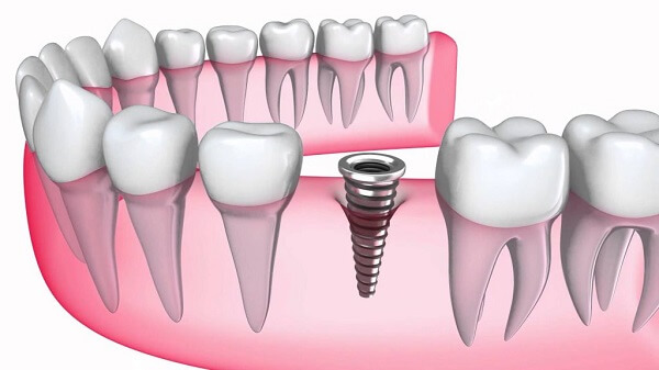 titanium-trong-trong-rang-implant-5