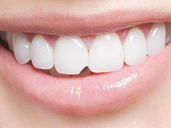 Có thể trám răng sứ bị hỏng không?