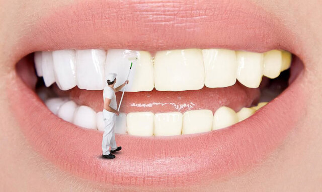 Giới thiệu về tráng men răng