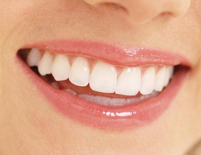 Ưu và nhược điểm của tráng men răng