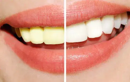 Trường hợp nên tráng men răng
