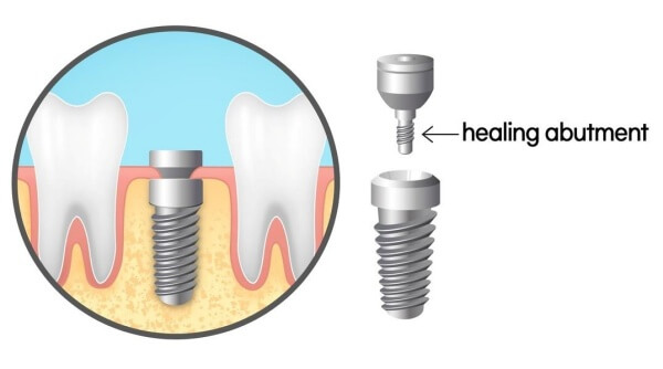 vai-tro-cua-healing-trong-qua-trinh-cay-ghep-implant-4