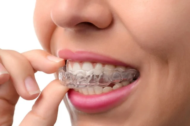 Thế nào là hàm duy trì sau niềng?