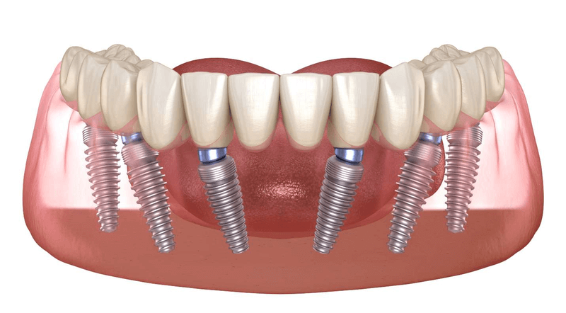 implant-all-on-6-1
