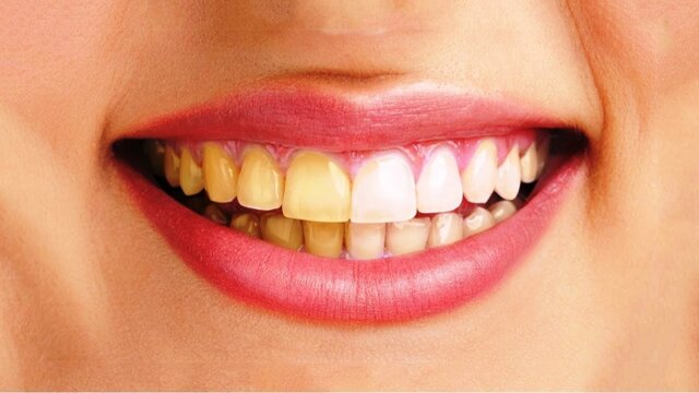 Hướng dẫn uống trà mà không làm ố vàng răng