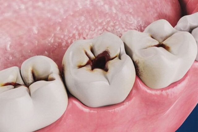 Sâu răng có thể lây lan theo những con đường nào?