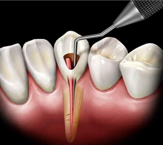 Những dấu hiệu bình thường và bất thường sau khi chữa tủy