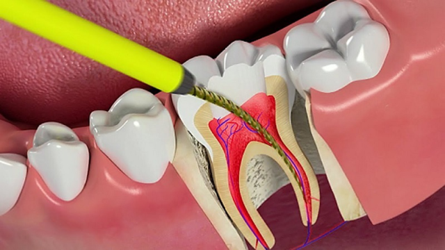 Lấy tủy răng rồi vẫn đau là vì sao?