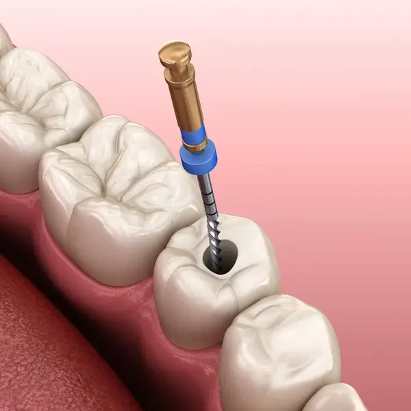Lấy tủy răng lần 2 có đau không?