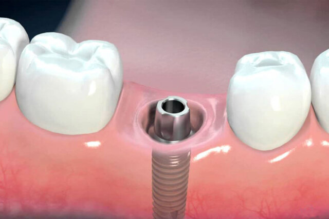Bệnh nhân tiểu đường có thể trồng răng Implant không?