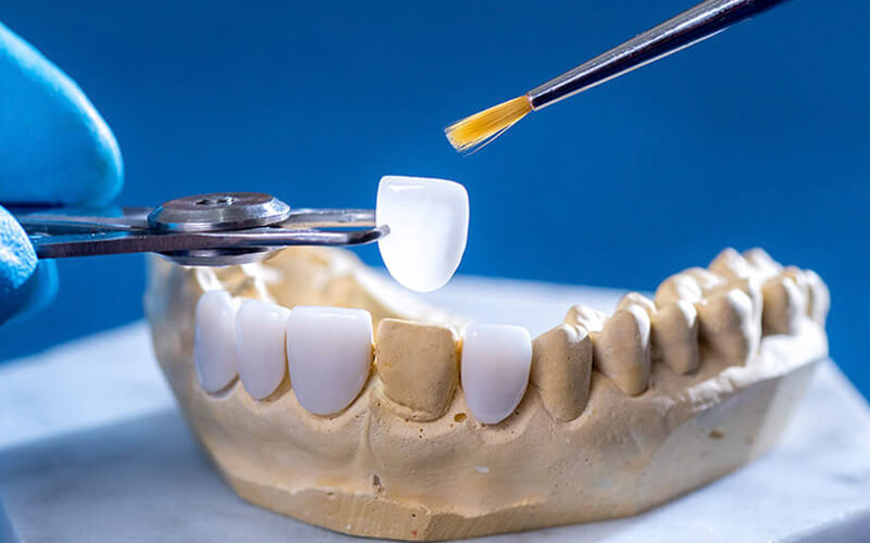quy-trinh-dan-veneer-3