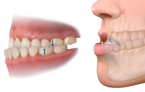 Niềng răng bị quặp được không?