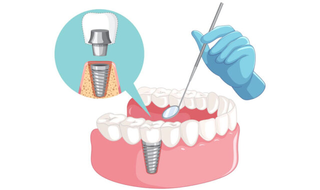 Tiêu chí đánh giá bác sĩ cấy ghép Implant giỏi?