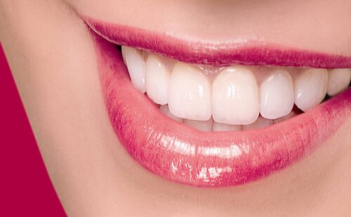 Các trường hợp nên bọc răng sứ cho hàm trên