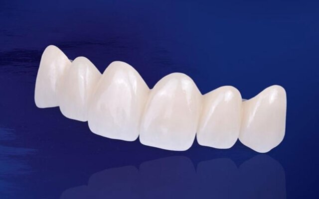 Cần quan tâm đến những thông tin gì khi bọc răng sứ hàm trên?