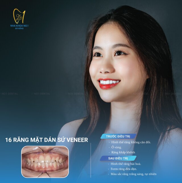 Dáng vẻ tự tin của khách hàng No1 Dental sau khi dán sứ Veneer