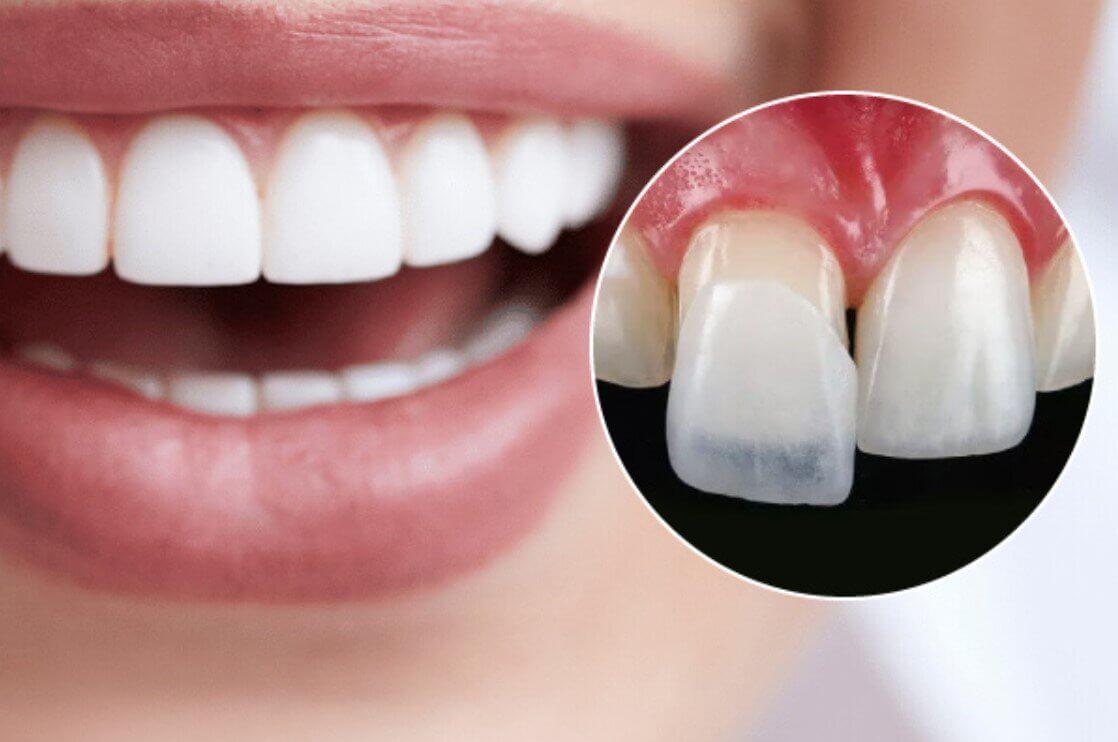 dan-su-veneer-2-rang-cua-1