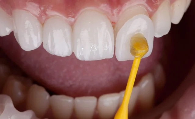 Những ai có thể dán sứ Veneer cho răng cửa?