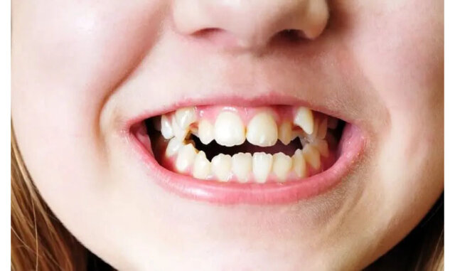 Những tác nhân có thể ảnh hưởng khả năng nhai