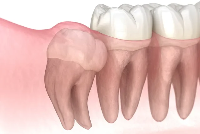 Mọc răng khôn có nguy hiểm không?