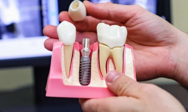 5 nguyên nhân phổ biến của tình trạng răng Implant bị mắc thức ăn