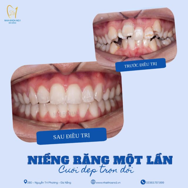 Giải cứu thành công tình trạng răng lệch lạc tại No1 Dental