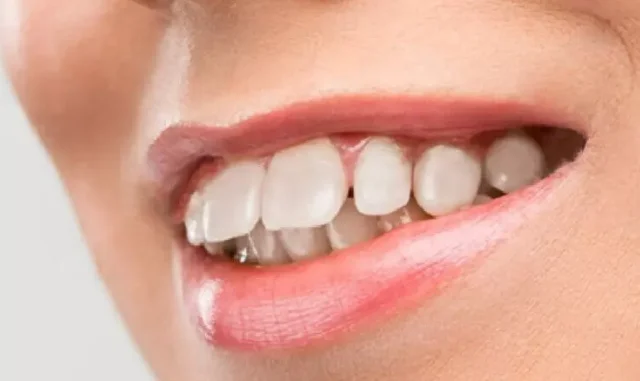 Phân loại các trường hợp răng vẩu