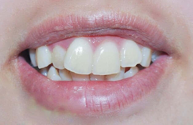 Biện pháp khắc phục răng bị vẩu