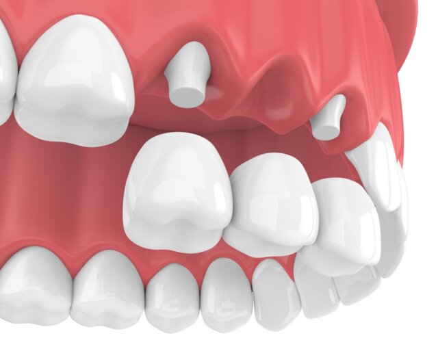 Bắc cầu răng sứ là một trong những phương pháp có thể khắc phục thiếu mầm răng vĩnh viễn