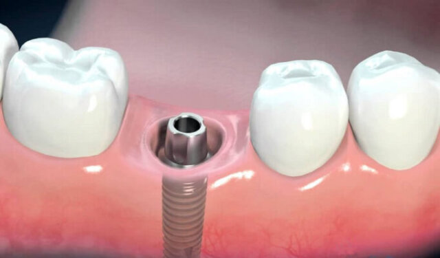 Tuổi thọ răng implant phụ thuộc vào nhiều yếu tố khác nhau