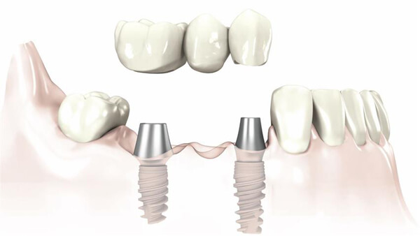 Làm gì để tăng tuổi thọ cho răng Implant?