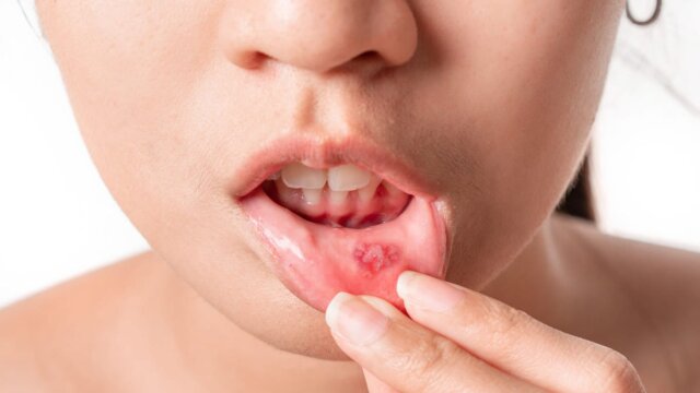 Hướng dẫn cách xử lý khi liên tục bị nhiệt miệng