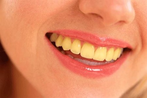 Những tác nhân khác gây ra tình trạng đổi màu răng