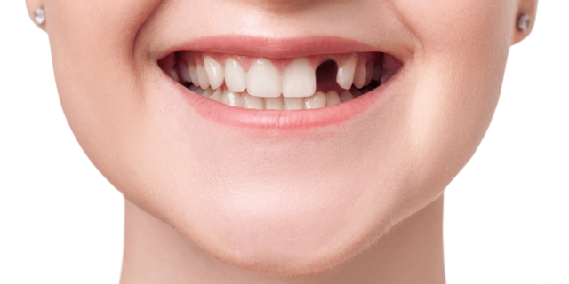 Những ảnh hưởng đến từ mất răng số 2