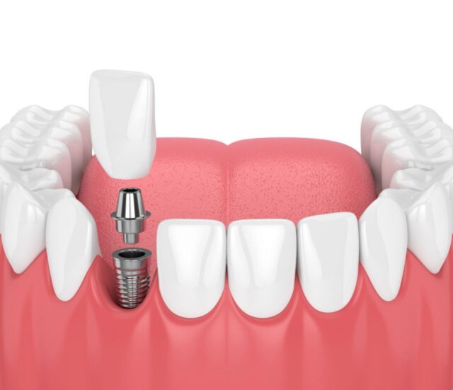 Biện pháp khắc phục vấn đề mất răng 
