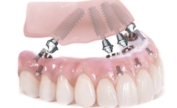 nen-cay-ghep-implant-gia-re-hay-khong-1