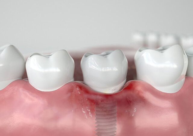 Vì sao xuất hiện răng Implant giá rẻ?