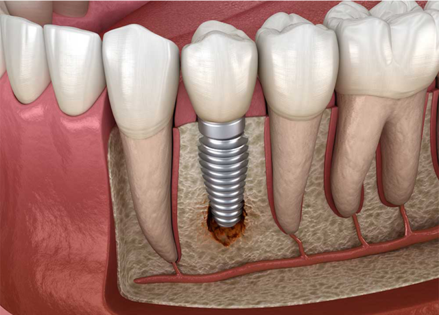 Bí quyết trồng Implant hiệu quả và chất lượng