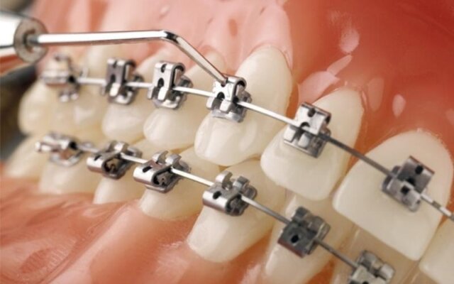 Ưu nhược điểm của niềng răng mắc cài tự đóng