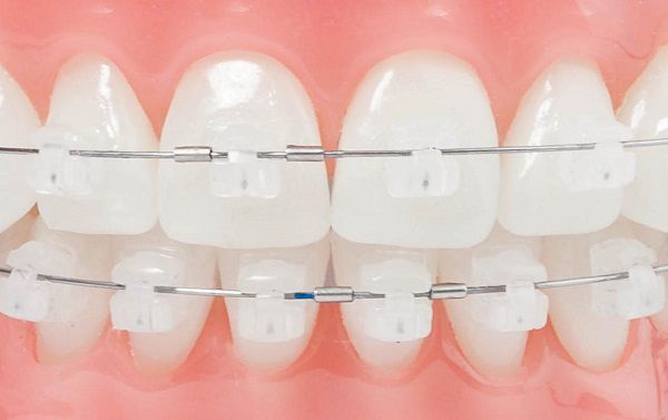 Niềng răng mắc cài sứ tự buộc