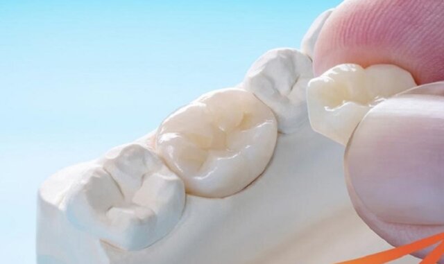Bọc răng sứ là một trong những kỹ thuật phục hình răng nổi bật