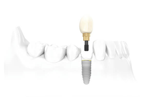 Những đối tượng nào phù hợp cấy Implant?