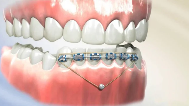 Tổng quan về kỹ thuật cắm minivis trong niềng răng