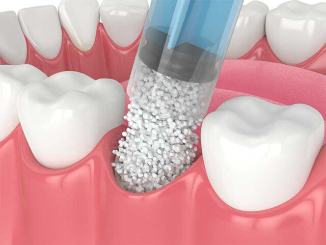 Khám phá ghép xương nhân tạo và ghép xương tự thân