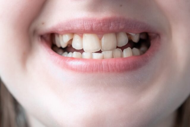 Giải mã hiện tượng trẻ em nghiến răng