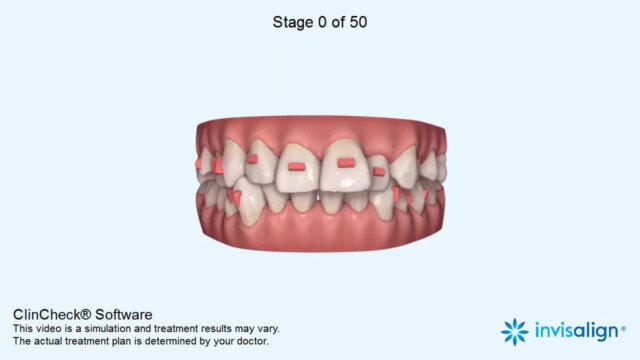 Clincheck trong niềng răng Invisalign mang đến rất nhiều lợi ích